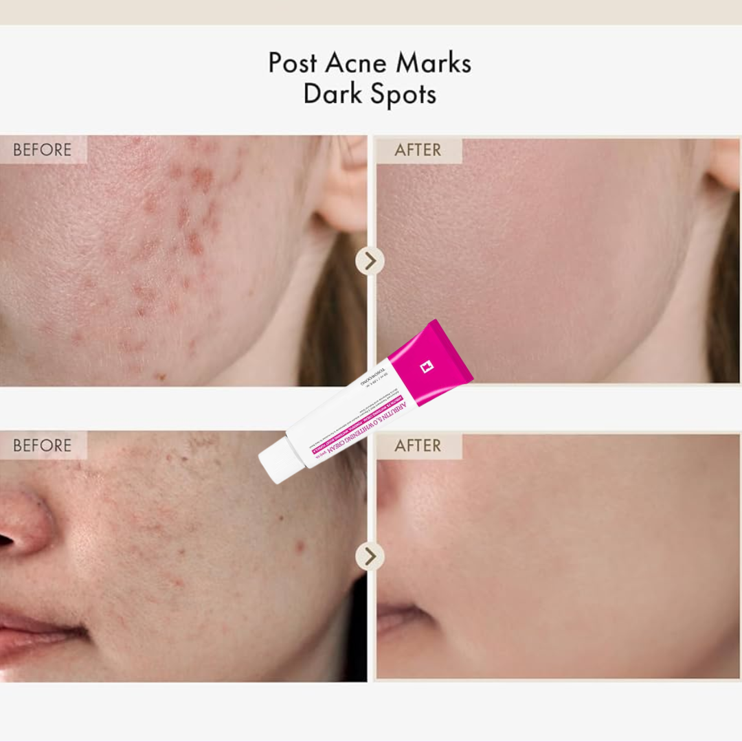 Arbutin Intensive Spot Cream (Remove acne spots & pigmentation + Gives Clear & Bright Skin)
