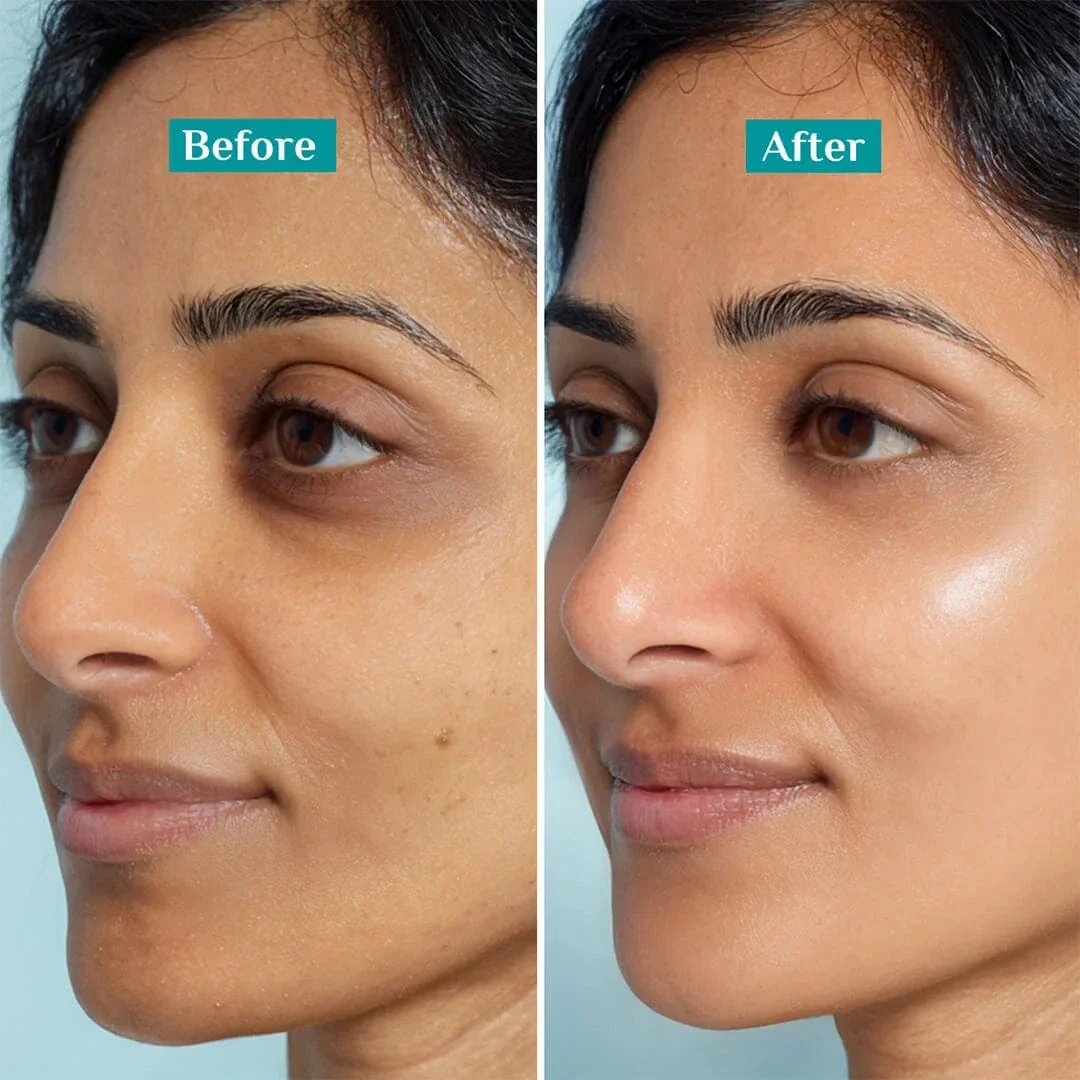 Emolene Cream 100g - Intense Moisturizer for Dry Skin, Smoothens & Helps Fade Marks & Acne Spots