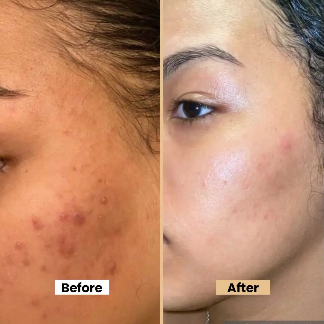 Emolene Cream 100g - Intense Moisturizer for Dry Skin, Smoothens & Helps Fade Marks & Acne Spots